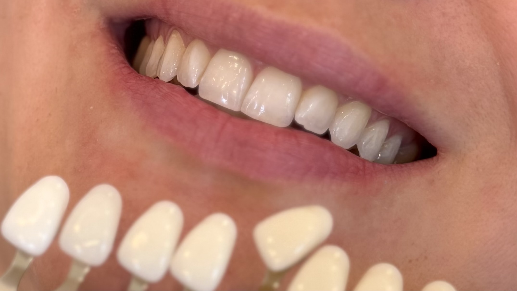 After whitening