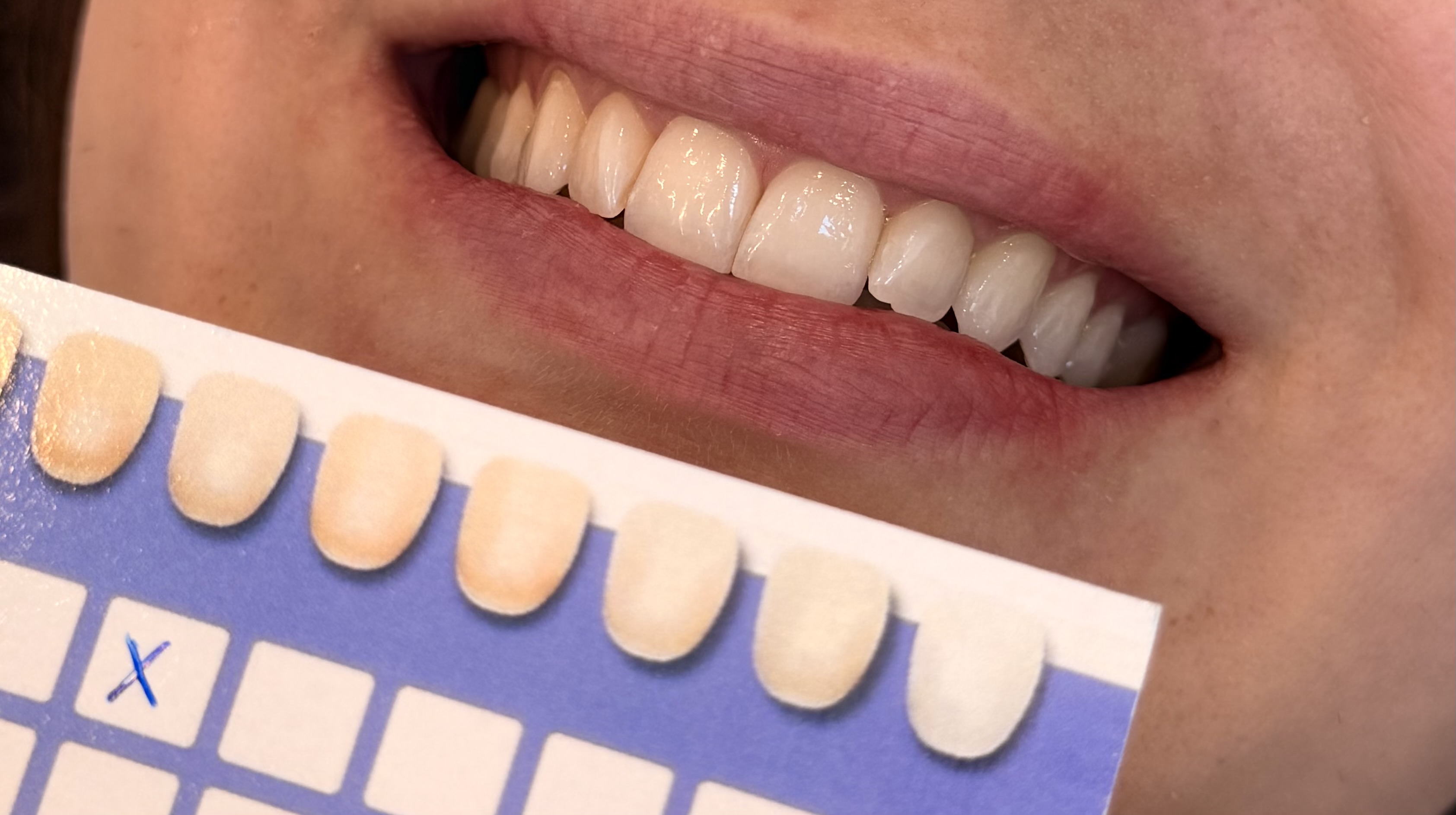 Before whitening