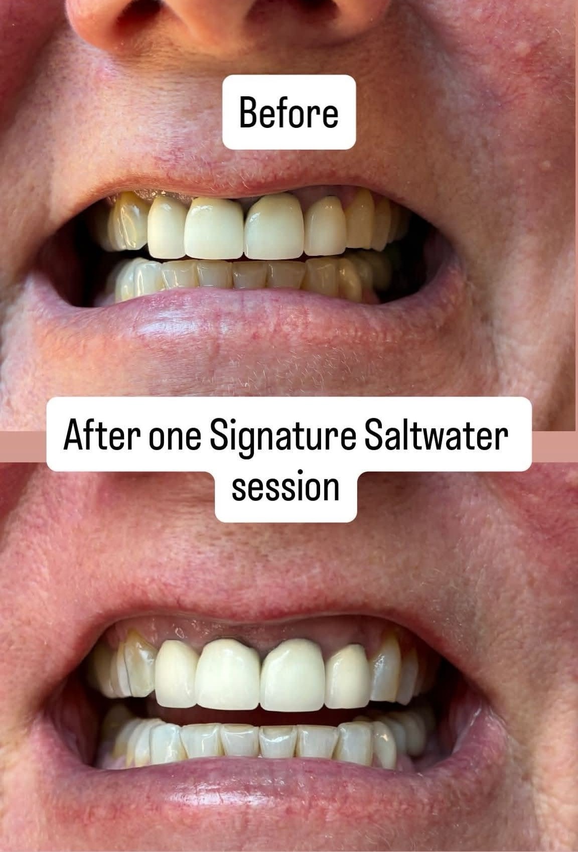 Before and after one Signature Saltwater whitening session