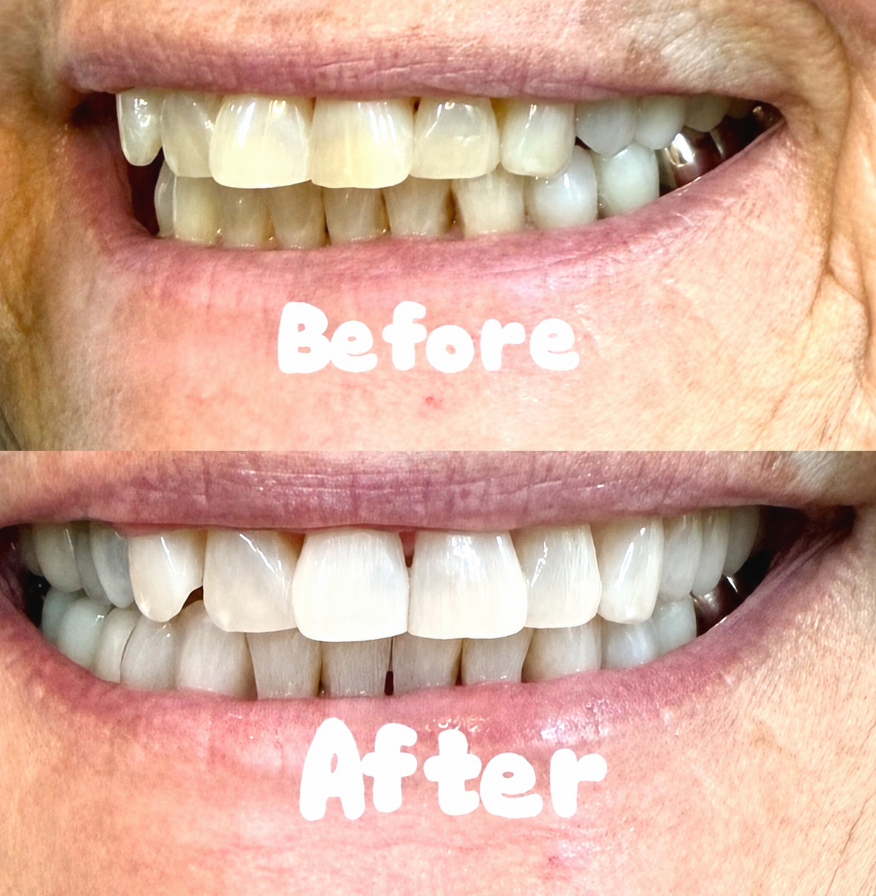 Before and after whitening