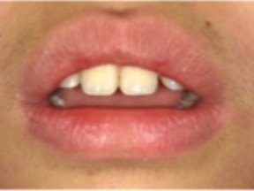 A child's lips resting apart, with the front teeth showing.
