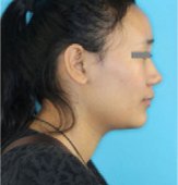 The same profile after treatment, with relaxed, closed lips.