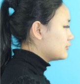 Side profile of a young woman before treatment, with protruding lips.