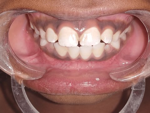 The same teeth after 3 months, with the upper and lower front teeth meeting.