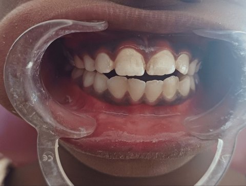 Front teeth that do not meet, leaving a gap between the upper and lower teeth.