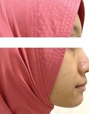 The same girl's profile 12 months later, with the lower jaw and chin further forward.