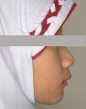Side profile of a 9-year-old girl with a receding lower jaw and chin.