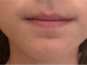 The same child swallowing after 6 months, with relaxed lips and chin.