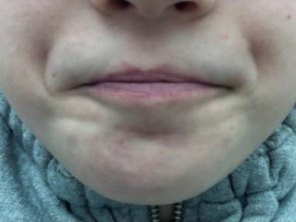 A child's lower face while swallowing, with the lips and chin visibly straining.